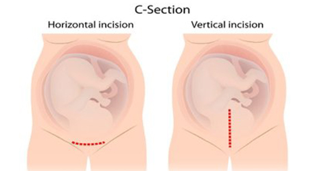 face presentation and c section