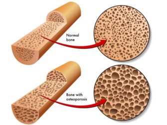 An example of what osteoporosis looks like.